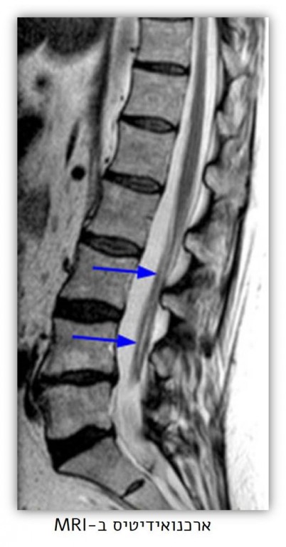 arachno mri