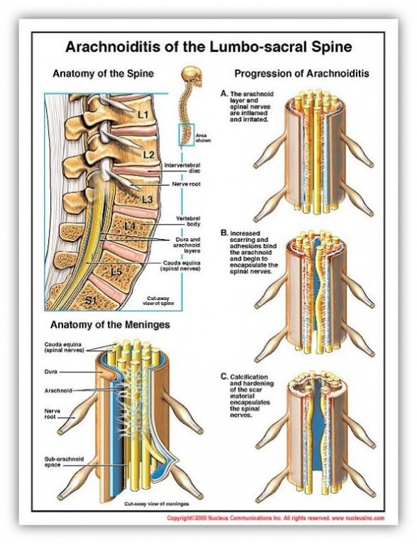 arachno pathology