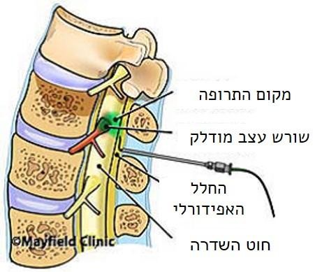epidural heb