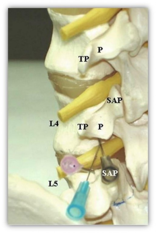 epidural l4 5