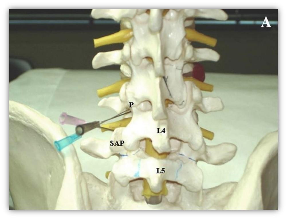 epidural l4 l5 sap